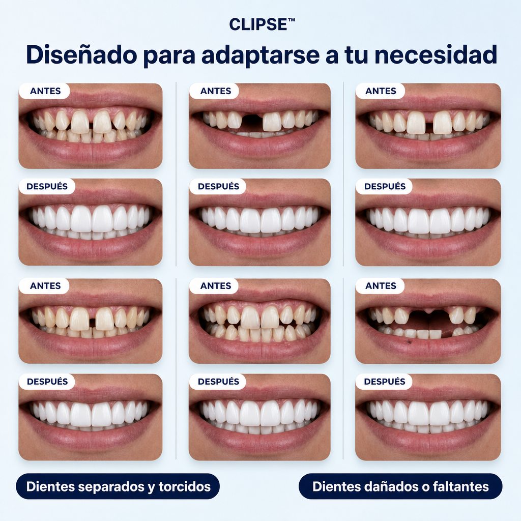 Carillas Postiza Dentadura SnapOn Smile